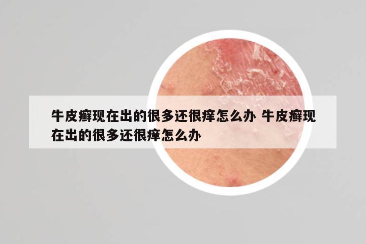 牛皮癣现在出的很多还很痒怎么办 牛皮癣现在出的很多还很痒怎么办