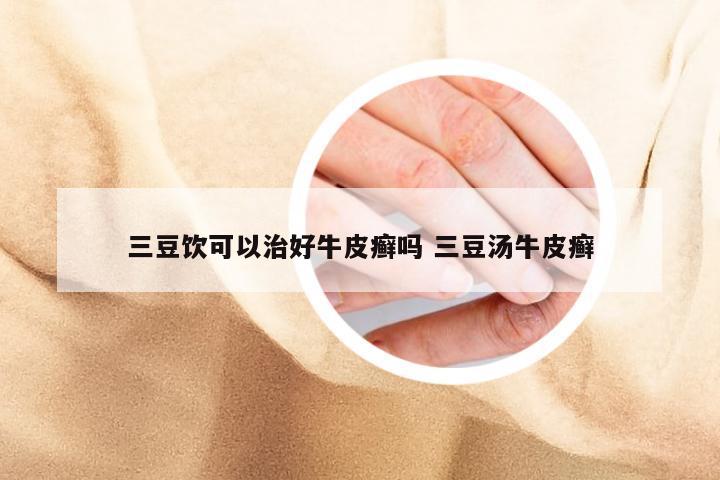 三豆饮可以治好牛皮癣吗 三豆汤牛皮癣
