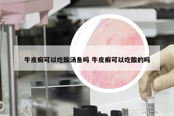 牛皮癣可以吃酸汤鱼吗 牛皮癣可以吃酸的吗