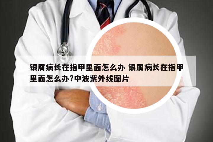 银屑病长在指甲里面怎么办 银屑病长在指甲里面怎么办?中波紫外线图片