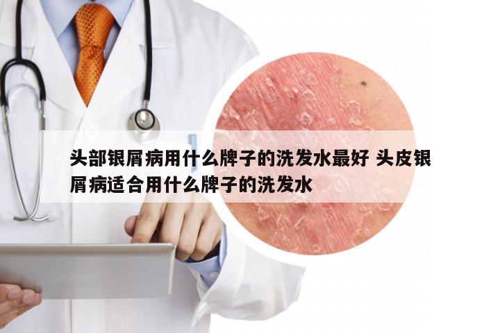 头部银屑病用什么牌子的洗发水最好 头皮银屑病适合用什么牌子的洗发水
