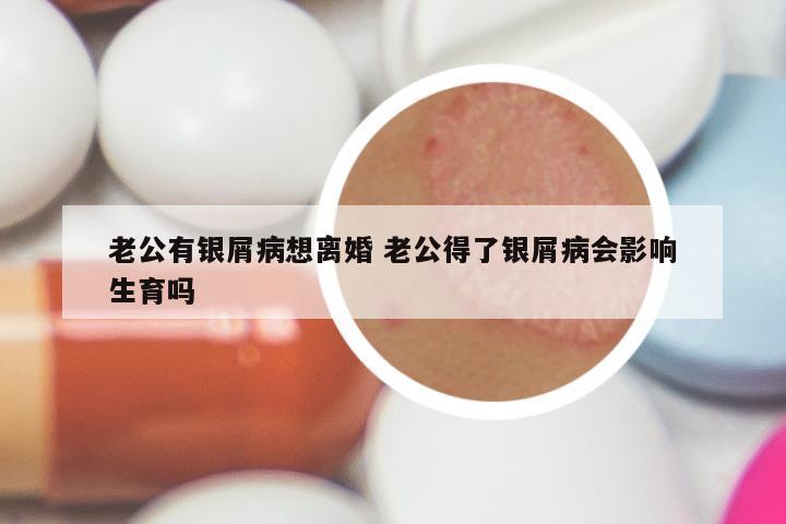 老公有银屑病想离婚 老公得了银屑病会影响生育吗