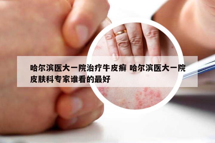 哈尔滨医大一院治疗牛皮癣 哈尔滨医大一院皮肤科专家谁看的最好