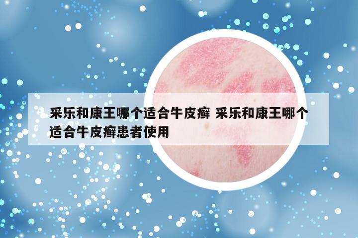 采乐和康王哪个适合牛皮癣 采乐和康王哪个适合牛皮癣患者使用