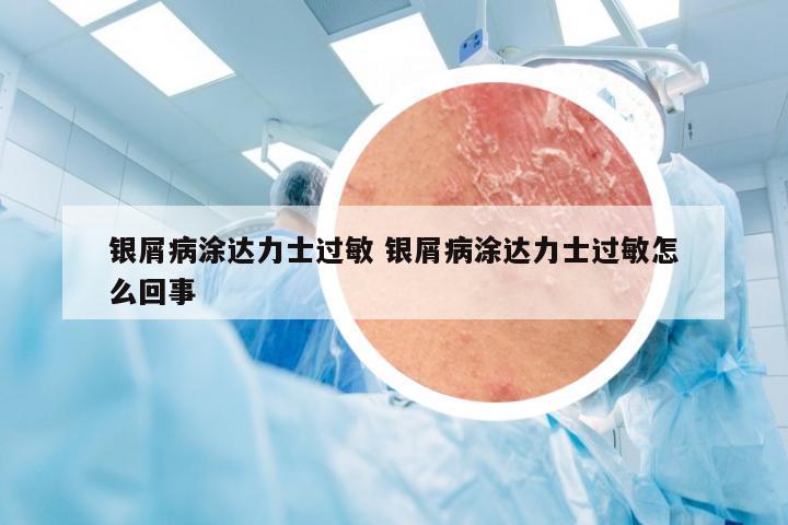 银屑病涂达力士过敏 银屑病涂达力士过敏怎么回事