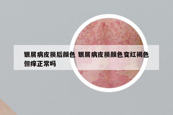 银屑病皮损后颜色 银屑病皮损颜色变红褐色但痒正常吗