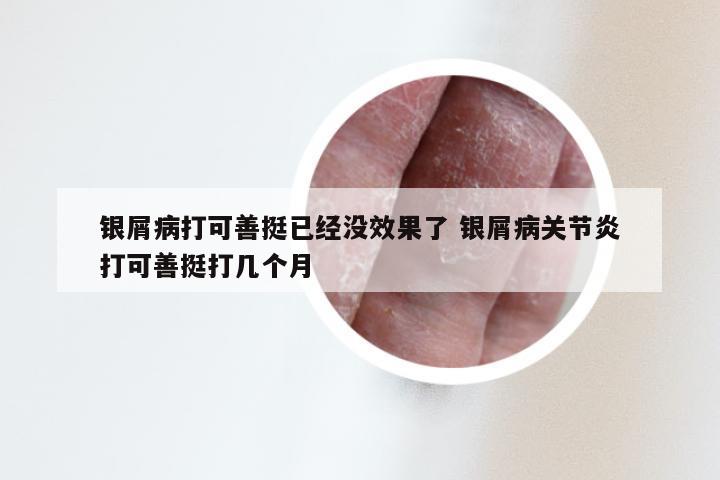 银屑病打可善挺已经没效果了 银屑病关节炎打可善挺打几个月