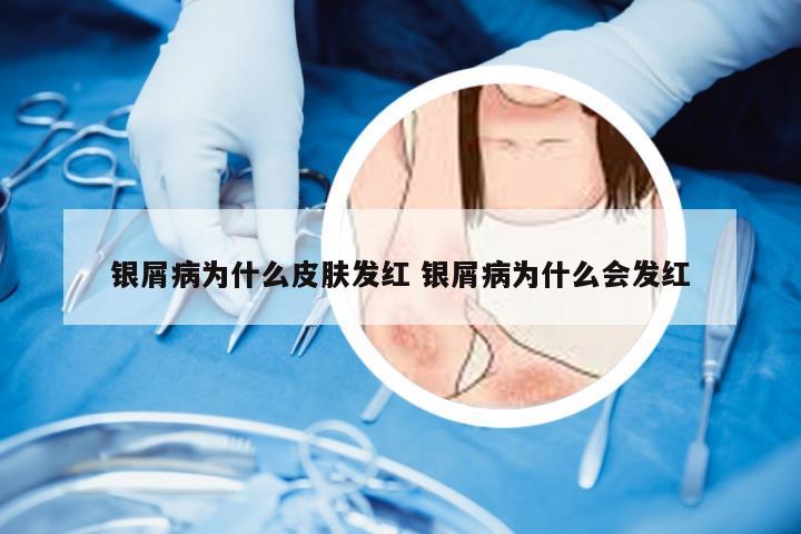 银屑病为什么皮肤发红 银屑病为什么会发红