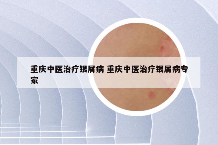 重庆中医治疗银屑病 重庆中医治疗银屑病专家