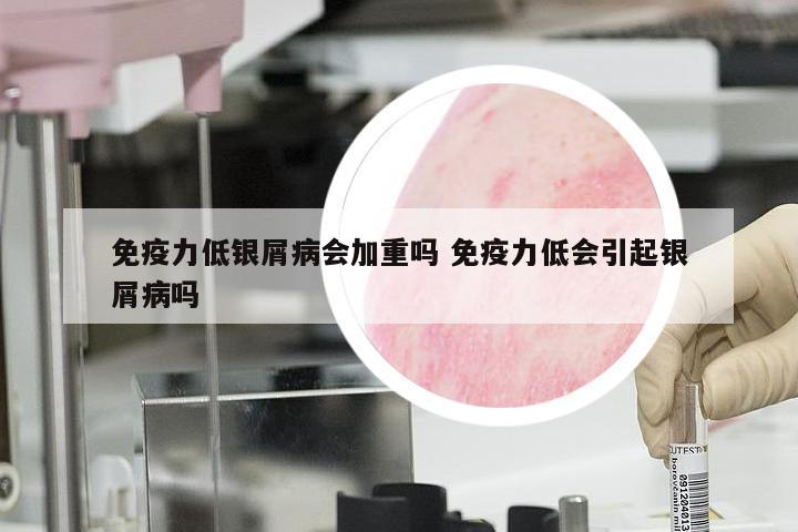 免疫力低银屑病会加重吗 免疫力低会引起银屑病吗