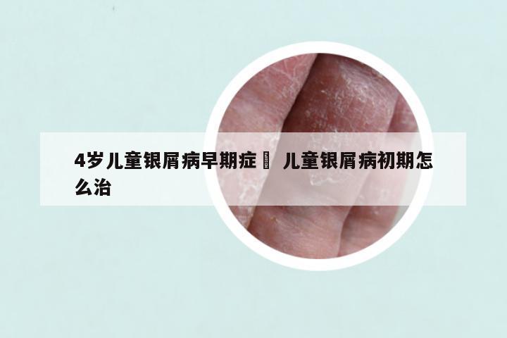 4岁儿童银屑病早期症狀 儿童银屑病初期怎么治