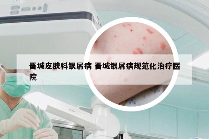 晋城皮肤科银屑病 晋城银屑病规范化治疗医院