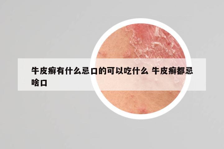 牛皮癣有什么忌口的可以吃什么 牛皮癣都忌啥口