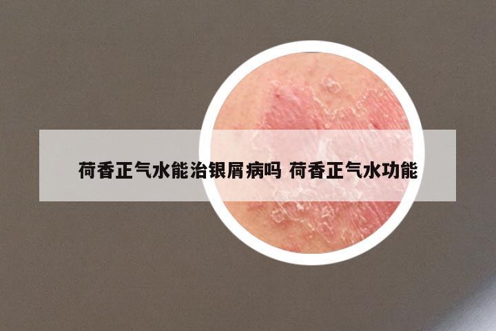 荷香正气水能治银屑病吗 荷香正气水功能