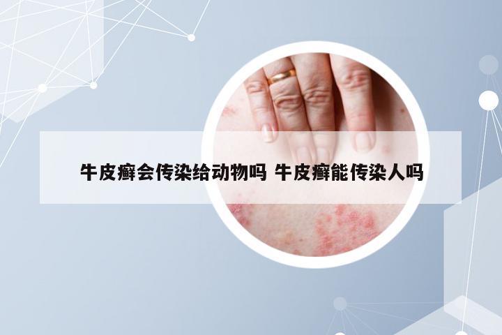 牛皮癣会传染给动物吗 牛皮癣能传染人吗