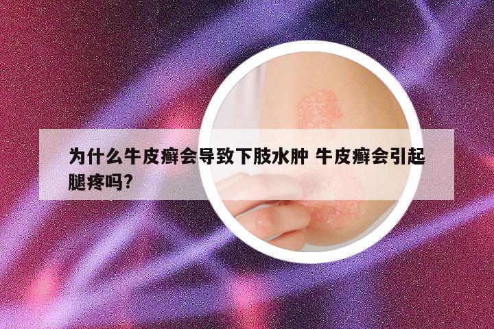 为什么牛皮癣会导致下肢水肿 牛皮癣会引起腿疼吗?
