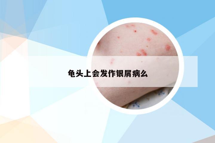 龟头上会发作银屑病么