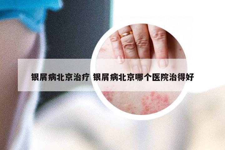银屑病北京治疗 银屑病北京哪个医院治得好