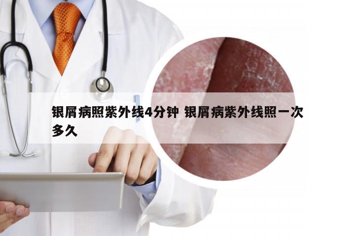 银屑病照紫外线4分钟 银屑病紫外线照一次多久