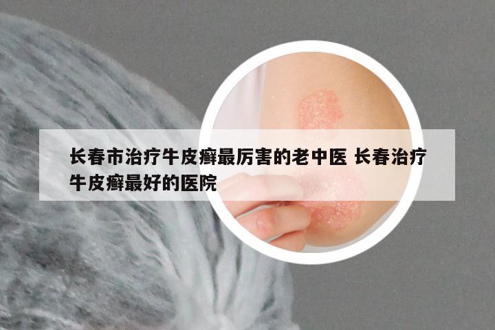 长春市治疗牛皮癣最厉害的老中医 长春治疗牛皮癣最好的医院