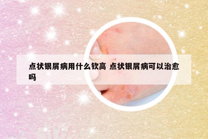 点状银屑病用什么钦高 点状银屑病可以治愈吗