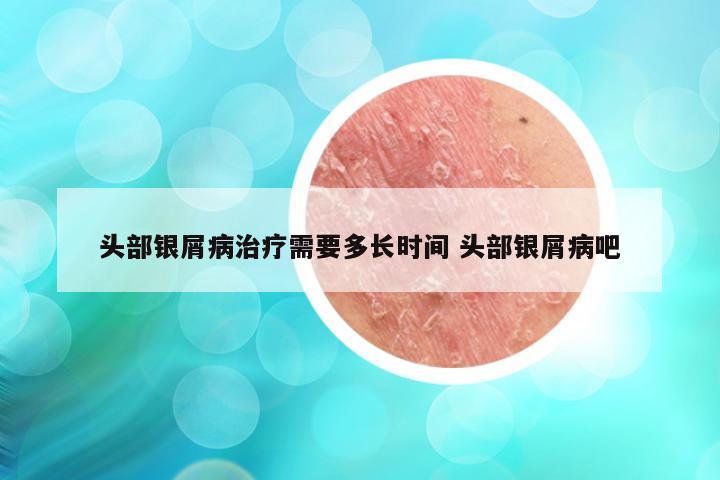 头部银屑病治疗需要多长时间 头部银屑病吧