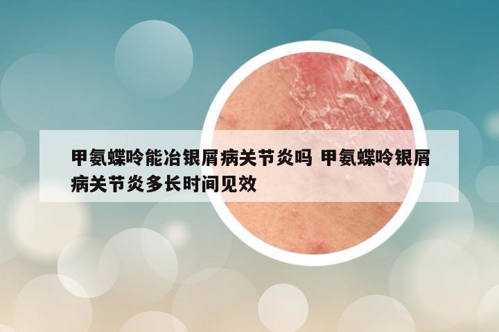 甲氨蝶呤能冶银屑病关节炎吗 甲氨蝶呤银屑病关节炎多长时间见效