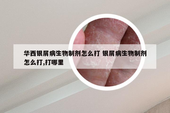 华西银屑病生物制剂怎么打 银屑病生物制剂怎么打,打哪里