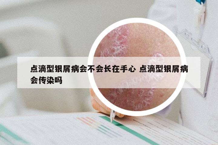 点滴型银屑病会不会长在手心 点滴型银屑病会传染吗