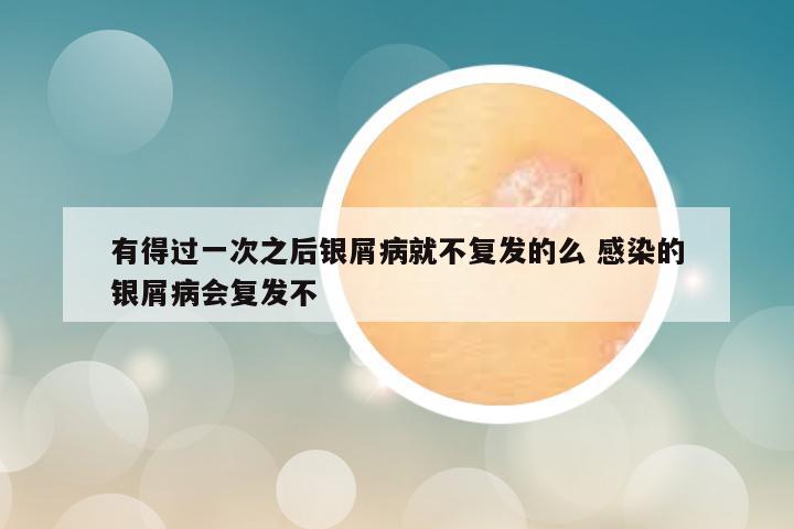 有得过一次之后银屑病就不复发的么 感染的银屑病会复发不