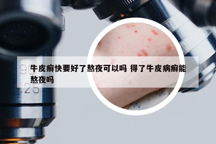 牛皮癣快要好了熬夜可以吗 得了牛皮病癣能熬夜吗
