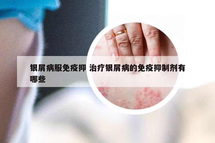 银屑病服免疫抑 治疗银屑病的免疫抑制剂有哪些