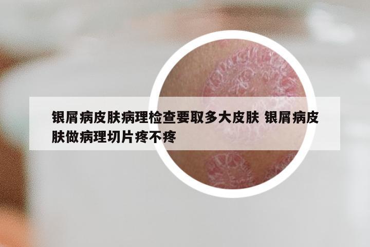 银屑病皮肤病理检查要取多大皮肤 银屑病皮肤做病理切片疼不疼