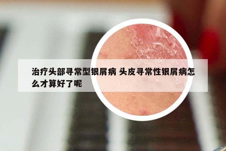 治疗头部寻常型银屑病 头皮寻常性银屑病怎么才算好了呢