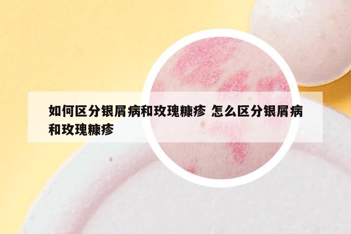 如何区分银屑病和玫瑰糠疹 怎么区分银屑病和玫瑰糠疹