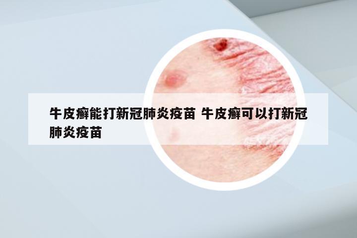 牛皮癣能打新冠肺炎疫苗 牛皮癣可以打新冠肺炎疫苗