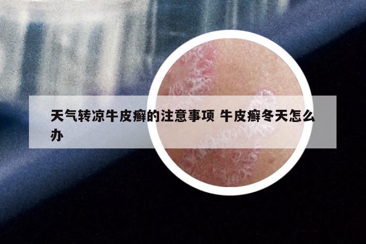 天气转凉牛皮癣的注意事项 牛皮癣冬天怎么办
