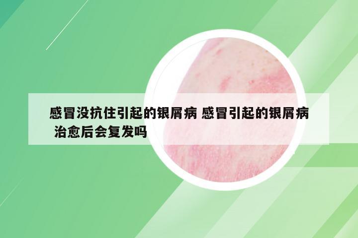 感冒没抗住引起的银屑病 感冒引起的银屑病 治愈后会复发吗