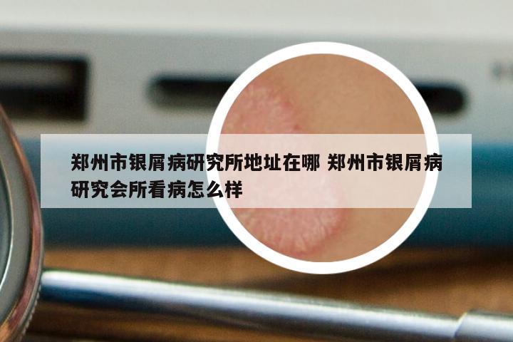郑州市银屑病研究所地址在哪 郑州市银屑病研究会所看病怎么样