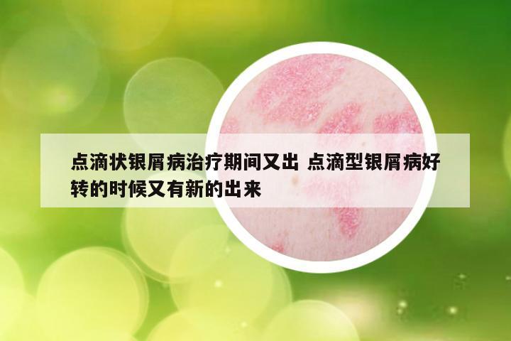 点滴状银屑病治疗期间又出 点滴型银屑病好转的时候又有新的出来
