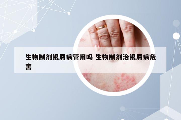 生物制剂银屑病管用吗 生物制剂治银屑病危害