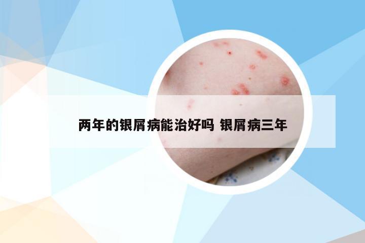 两年的银屑病能治好吗 银屑病三年