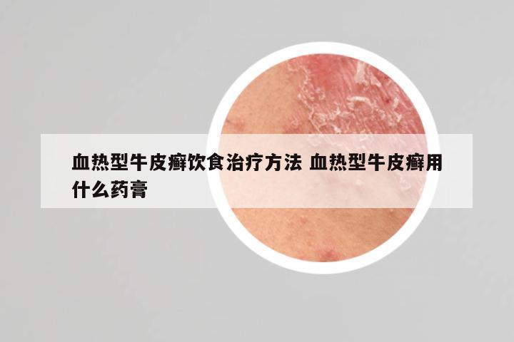 血热型牛皮癣饮食治疗方法 血热型牛皮癣用什么药膏