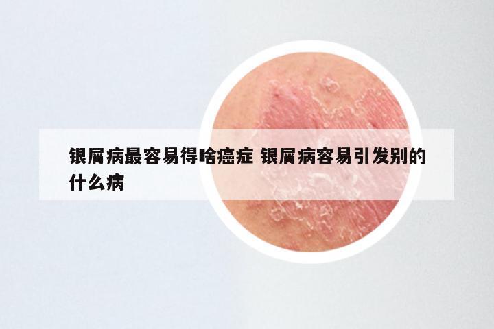 银屑病最容易得啥癌症 银屑病容易引发别的什么病