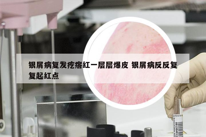 银屑病复发疙瘩红一层层爆皮 银屑病反反复复起红点