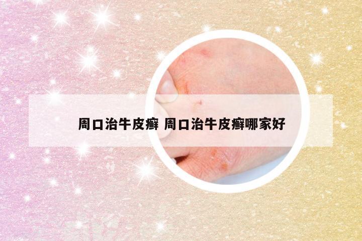 周口治牛皮癣 周口治牛皮癣哪家好