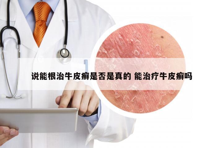 说能根治牛皮癣是否是真的 能治疗牛皮癣吗