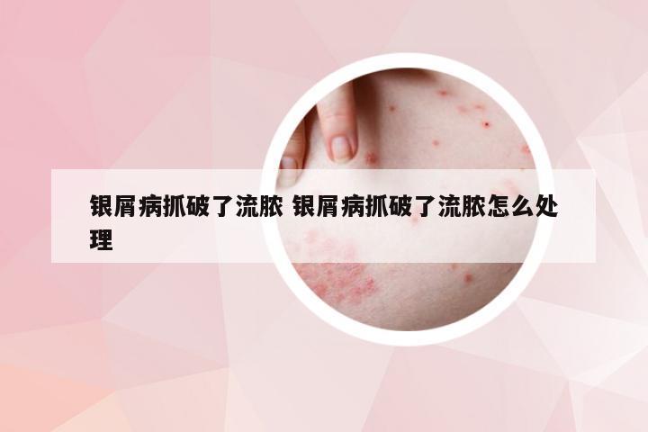 银屑病抓破了流脓 银屑病抓破了流脓怎么处理