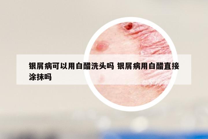银屑病可以用白醋洗头吗 银屑病用白醋直接涂抹吗