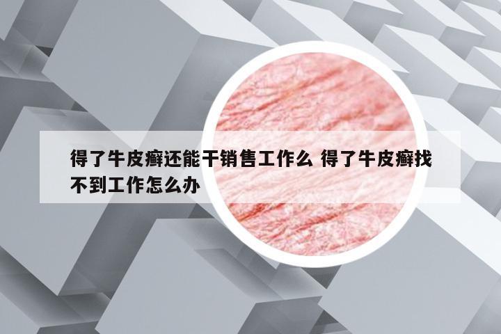 得了牛皮癣还能干销售工作么 得了牛皮癣找不到工作怎么办